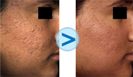 Laser Fraxel : cicatrices d'acné
