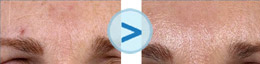 Laser Fraxel : resserrer les pores